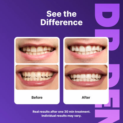 Experience a Radiant Smile with DRDENT Purple Teeth Whitening Strips - 14 or 42 Sessions of Gentle, Peroxide-Free Whitening for Sensitive Teeth